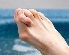 Bunion Surgery